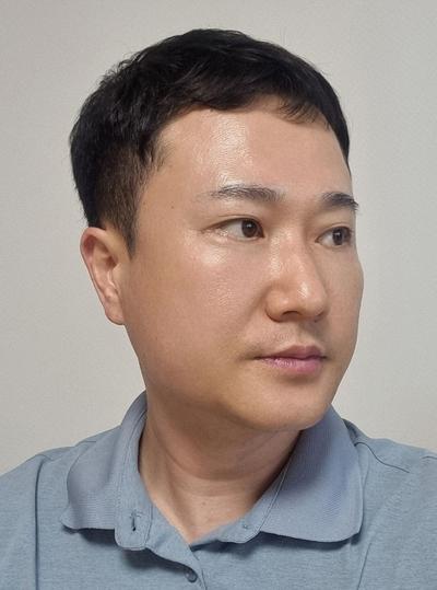 눈밑지방재배치에 하안검까지, 피곤해 보인다는 말 들어서 했어요 사진 4 — 아바성형외과 눈밑지방재배치 후기