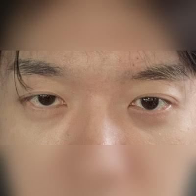 안면거상 환자 후기 — 수술 한쪽 삼백안이 있었는데... (239)