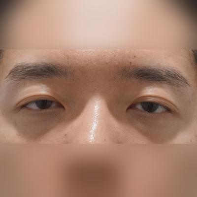 중안면거상＋눈밑지방재배치 한달차, 인상 밝아졌다는 말 정말 많이 들어요 사진 2 — 아바성형외과 눈밑지방재배치 후기