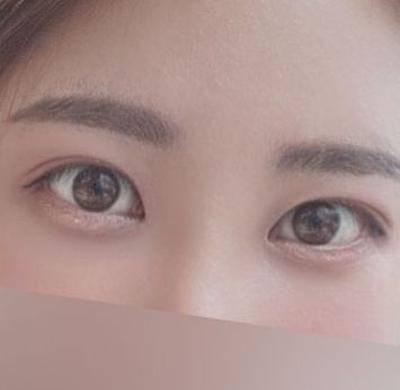 눈밑지방재배치 6주차, 어려지고 생기 있어서 진작 할 걸 — 아바성형외과 환자 후기 사진