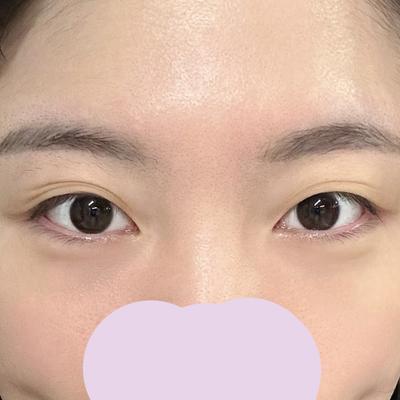 눈밑지방재배치 8주차, 애굣살 더 돋보여서 완전 만족이에요 — 아바성형외과 환자 후기 사진