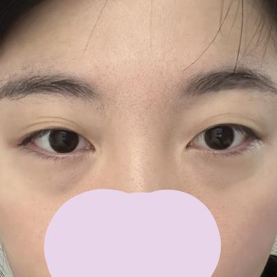 눈밑지방재배치 8주차, 애굣살 더 돋보여서 완전 만족이에요 사진 2 — 아바성형외과 눈밑지방재배치 후기