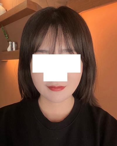 아큐스컬프 7주차, 턱처짐 없이 턱선 매끈해졌어요 — 아바성형외과 환자 후기 사진