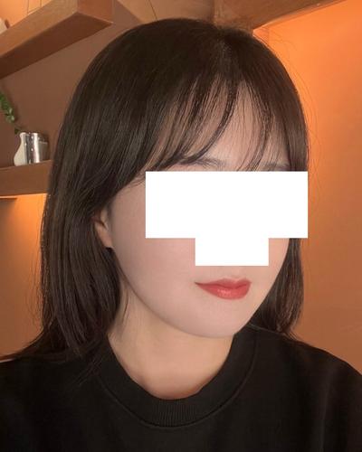 아큐스컬프 7주차, 턱처짐 없이 턱선 매끈해졌어요 사진 5 — 아바성형외과 지방이식 후기