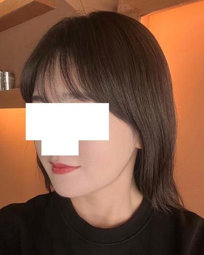 아큐스컬프 7주차, 턱처짐 없이 턱선 매끈해졌어요 사진 6 — 아바성형외과 지방이식 후기