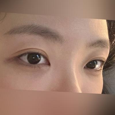 눈밑지방재배치 4주차, 얼굴 밝아졌다는 말 들어요 — 아바성형외과 환자 후기 사진