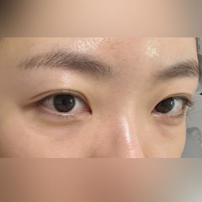 눈밑지방재배치 4주차, 얼굴 밝아졌다는 말 들어요 사진 2 — 아바성형외과 눈밑지방재배치 후기