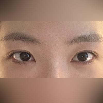 눈밑지방재배치 4주차, 얼굴 밝아졌다는 말 들어요 사진 4 — 아바성형외과 눈밑지방재배치 후기