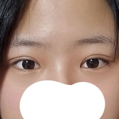 매몰쌍꺼풀 트임 눈매교정 4주차, 짝짝이 걱정했는데 라인 딱 나왔어요 — 아바성형외과 환자 후기 사진