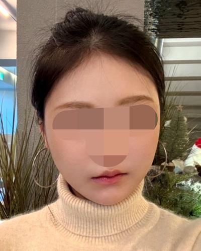 아큐 3주차, 이중턱 정리되고 턱라인이 확 달라졌어요 — 아바성형외과 환자 후기 사진