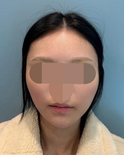 아큐 3주차, 이중턱 정리되고 턱라인이 확 달라졌어요 사진 2 — 아바성형외과 이중턱·윤곽 후기