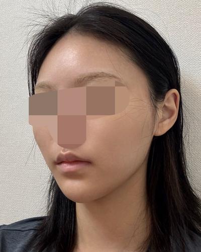 아큐 3주차, 이중턱 정리되고 턱라인이 확 달라졌어요 사진 4 — 아바성형외과 이중턱·윤곽 후기
