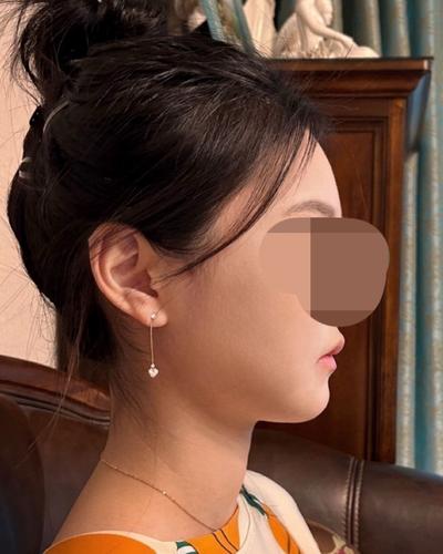 아큐 3주차, 이중턱 정리되고 턱라인이 확 달라졌어요 사진 5 — 아바성형외과 이중턱·윤곽 후기
