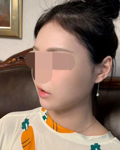 아큐 3주차, 이중턱 정리되고 턱라인이 확 달라졌어요 사진 6 — 아바성형외과 이중턱·윤곽 후기