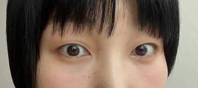 눈밑지방재배치 3개월차, 망설이지 말고 빨리 하세요 — 아바성형외과 환자 후기 사진