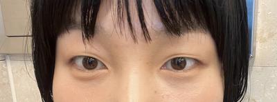 눈밑지방재배치 3개월차, 망설이지 말고 빨리 하세요 사진 4 — 아바성형외과 눈밑지방재배치 후기