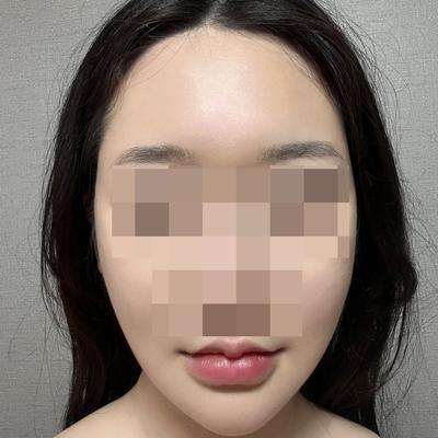 풀거상 5주차, 윤곽 잡히고 주변 반응이 진짜 뜨거워요 — 아바성형외과 환자 후기 사진