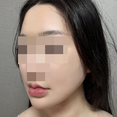 풀거상 5주차, 윤곽 잡히고 주변 반응이 진짜 뜨거워요 사진 5 — 아바성형외과 안면거상 후기