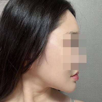 풀거상 5주차, 윤곽 잡히고 주변 반응이 진짜 뜨거워요 사진 6 — 아바성형외과 안면거상 후기