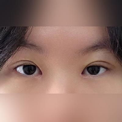 쌍꺼풀 윗트임 6주차, 인위적이지 않게 라인 예쁘게 잡혔어요 — 아바성형외과 환자 후기 사진