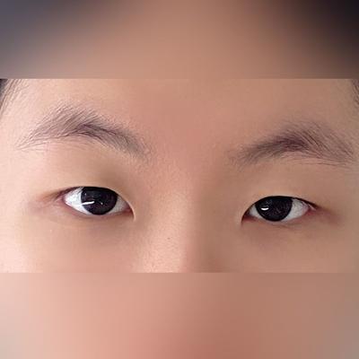 쌍꺼풀 윗트임 6주차, 인위적이지 않게 라인 예쁘게 잡혔어요 사진 2 — 아바성형외과 쌍꺼풀·눈성형 후기
