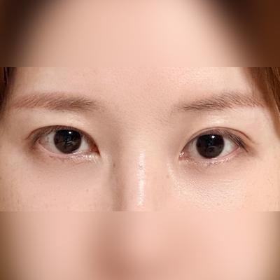 뒤밑트임 재수술＋눈밑지 6주차, 퀭한 느낌 완전 사라졌어요 — 아바성형외과 환자 후기 사진