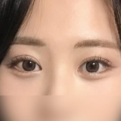 눈밑지방재배치 6주차, 다크서클 고민 끝내고 온 후기예요 — 아바성형외과 환자 후기 사진