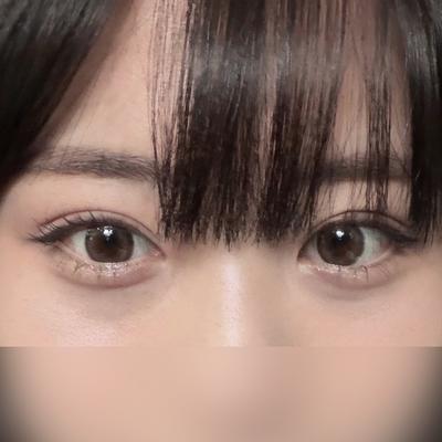 눈밑지방재배치 6주차, 다크서클 고민 끝내고 온 후기예요 사진 2 — 아바성형외과 눈밑지방재배치 후기