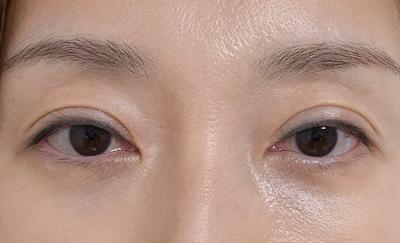 중안면거상 눈밑지방재배치 8주차, 시간 지나 더 자연스러워졌어요 — 아바성형외과 환자 후기 사진
