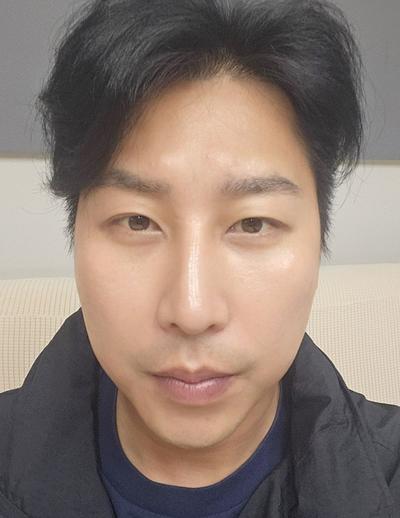 눈밑지방재배치 10주차, 왜 진작 안 했나 싶을 만큼 만족 — 아바성형외과 환자 후기 사진