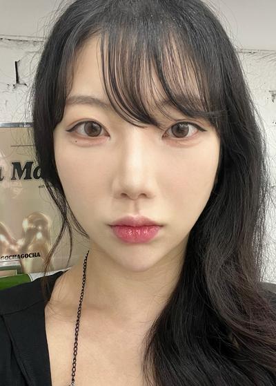 눈밑지방재배치 2주차, 컨실러 떡칠 안 해도 돼요 — 아바성형외과 환자 후기 사진