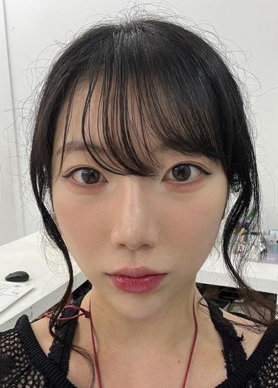 눈밑지방재배치 2주차, 컨실러 떡칠 안 해도 돼요 사진 2 — 아바성형외과 눈밑지방재배치 후기