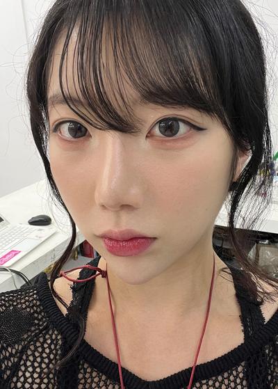 눈밑지방재배치 2주차, 컨실러 떡칠 안 해도 돼요 사진 3 — 아바성형외과 눈밑지방재배치 후기