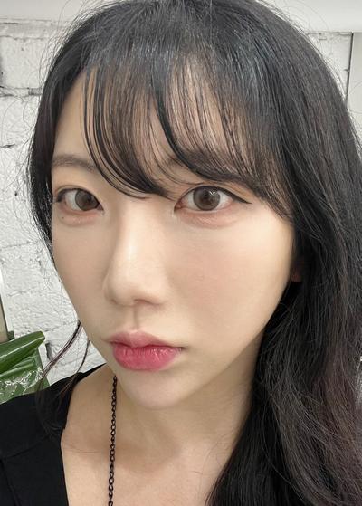 눈밑지방재배치 2주차, 컨실러 떡칠 안 해도 돼요 사진 4 — 아바성형외과 눈밑지방재배치 후기