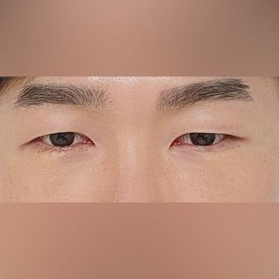 수술 경과 후기, 붓기 빠질수록 점점 더 좋아지네요 사진 1 — 아바성형외과 기타 후기