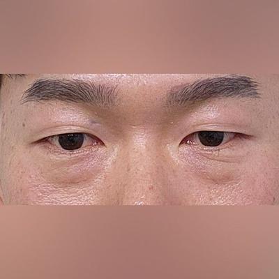 수술 경과 후기, 붓기 빠질수록 점점 더 좋아지네요 사진 2 — 아바성형외과 기타 후기