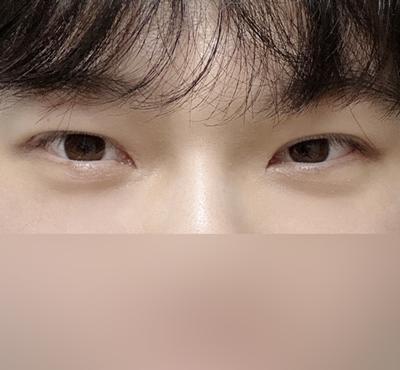 8주차, 피곤해보인다는 소리 이제 안 들어요 확실히 달라짐 — 아바성형외과 환자 후기 사진