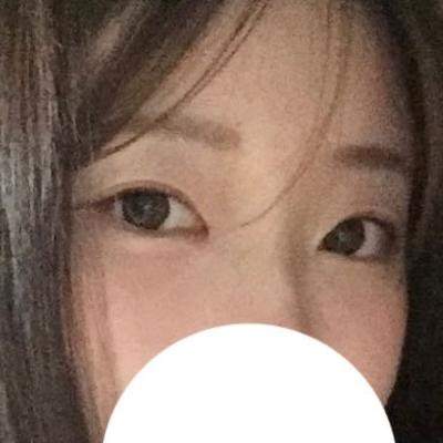 눈밑지방재배치 8주차, 심했던 다크서클 진짜 없어졌어요 — 아바성형외과 환자 후기 사진
