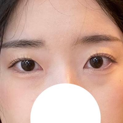 눈밑지방재배치 8주차, 심했던 다크서클 진짜 없어졌어요 사진 2 — 아바성형외과 눈밑지방재배치 후기