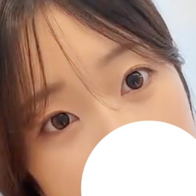 눈밑지방재배치 8주차, 심했던 다크서클 진짜 없어졌어요 사진 5 — 아바성형외과 눈밑지방재배치 후기