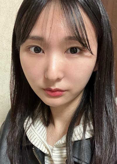 눈밑꺼짐 수술, 화장시간 줄고 피곤해 보이지 않아요 — 아바성형외과 환자 후기 사진