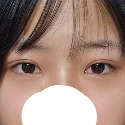쌍꺼풀 눈매교정 트임 6주차, 라인 완전 자연스러워졌어요 — 아바성형외과 환자 후기 사진