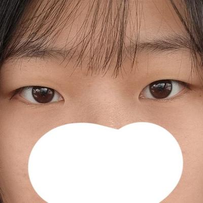 쌍꺼풀 눈매교정 트임 6주차, 라인 완전 자연스러워졌어요 사진 2 — 아바성형외과 쌍꺼풀·눈성형 후기