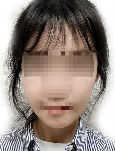 윤곽수술＋미니거상 5주차, 무턱이랑 턱라인 확 정리됐어요 — 아바성형외과 환자 후기 사진