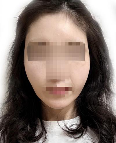 윤곽수술＋미니거상 5주차, 무턱이랑 턱라인 확 정리됐어요 사진 2 — 아바성형외과 안면거상 후기