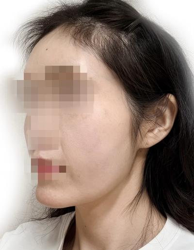 윤곽수술＋미니거상 5주차, 무턱이랑 턱라인 확 정리됐어요 사진 3 — 아바성형외과 안면거상 후기