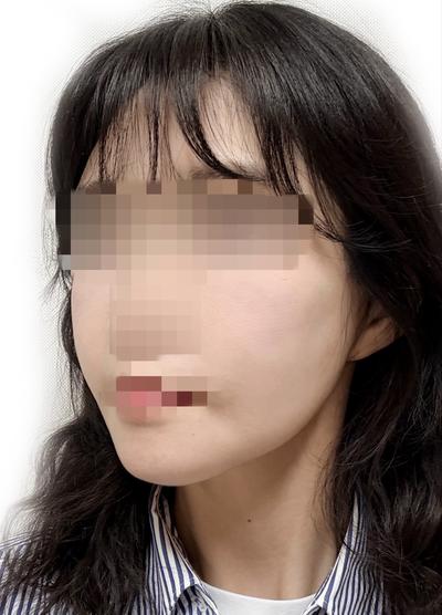 윤곽수술＋미니거상 5주차, 무턱이랑 턱라인 확 정리됐어요 사진 4 — 아바성형외과 안면거상 후기