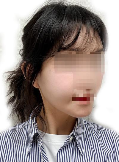 윤곽수술＋미니거상 5주차, 무턱이랑 턱라인 확 정리됐어요 사진 5 — 아바성형외과 안면거상 후기