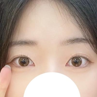 눈밑지방재배치 4주차, 다크서클 사라지고 애굣살까지 생겼어요 — 아바성형외과 환자 후기 사진