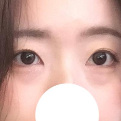 눈밑지방재배치 4주차, 다크서클 사라지고 애굣살까지 생겼어요 사진 2 — 아바성형외과 눈밑지방재배치 후기